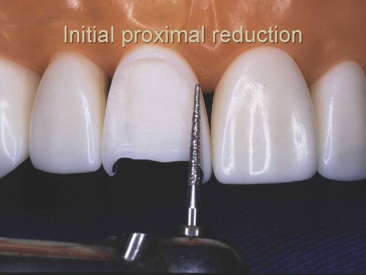 Initial proximal reduction 