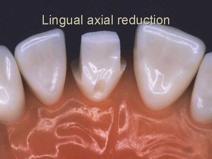 Lingual axial reduction 