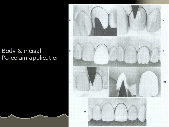 Body & incisal Porcelain application 