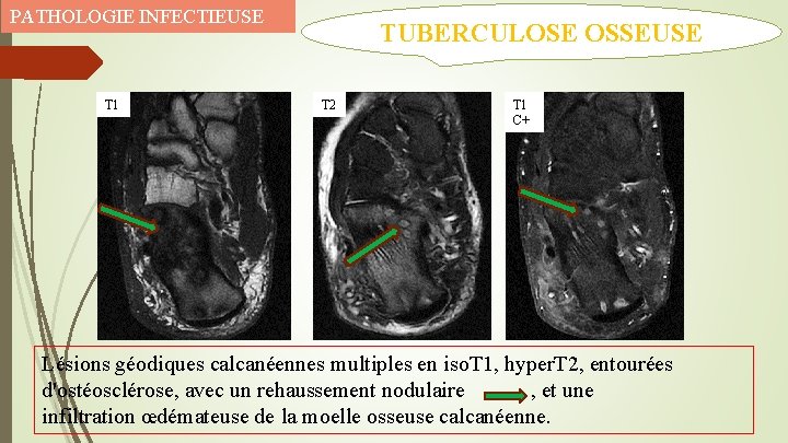 PATHOLOGIE INFECTIEUSE T 1 TUBERCULOSE OSSEUSE T 2 T 1 C+ Lésions géodiques calcanéennes