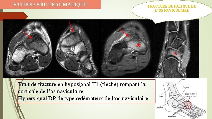 PATHOLOGIE TRAUMATIQUE FRACTURE DE FATIGUE DE L’OS NAVICULAIRE Trait de fracture en hyposignal T