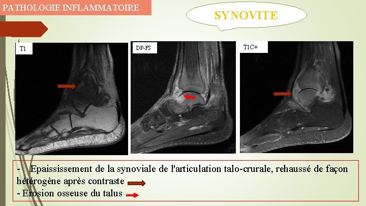 PATHOLOGIE INFLAMMATOIRE T 1 DP-FS SYNOVITE T 1 C+ - Epaississement de la synoviale