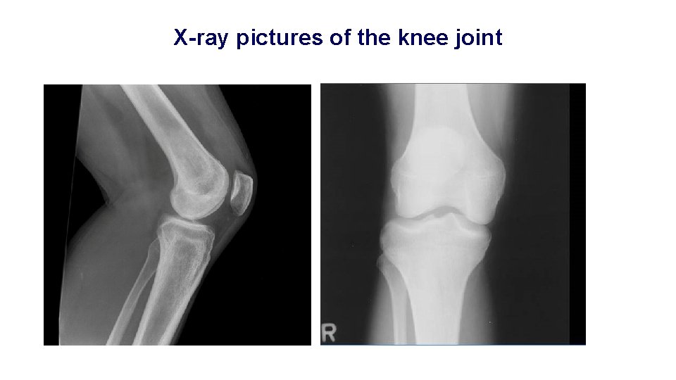 X-ray pictures of the knee joint 