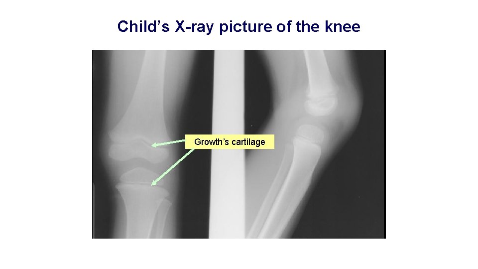 Child’s X-ray picture of the knee Growth’s cartilage 