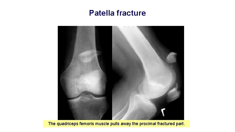 Patella fracture The quadriceps femoris muscle pulls away the proximal fractured part. 