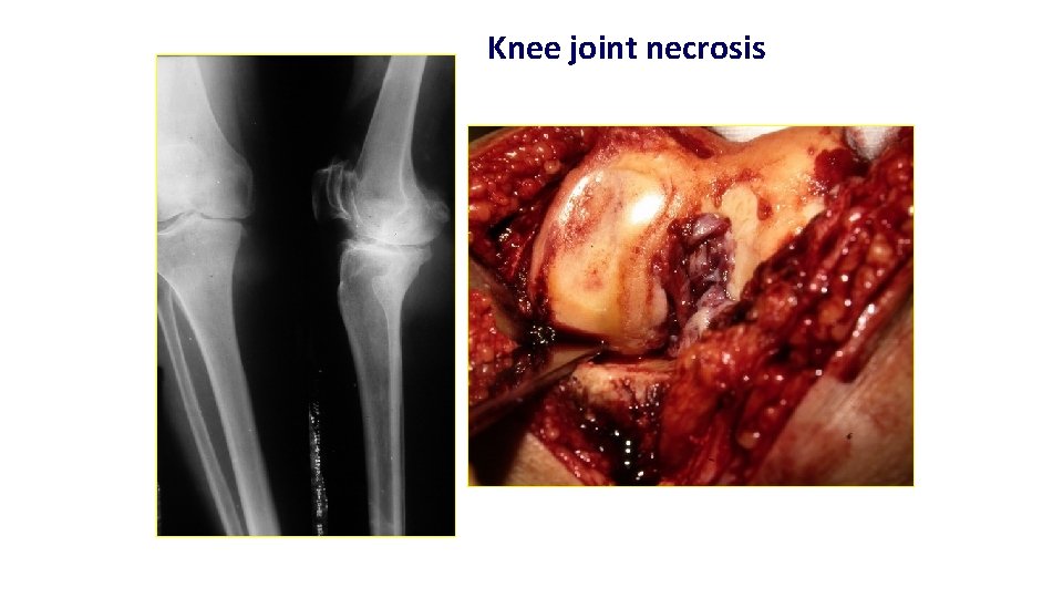 Knee joint necrosis 