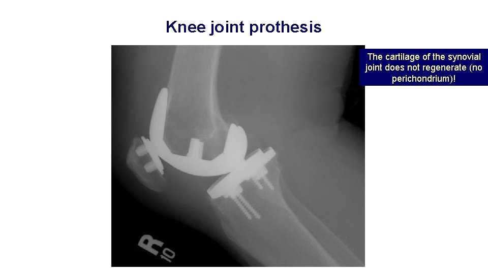 Knee joint prothesis The cartilage of the synovial joint does not regenerate (no perichondrium)!