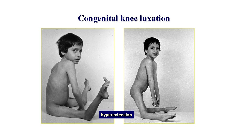 Congenital knee luxation hyperextension 