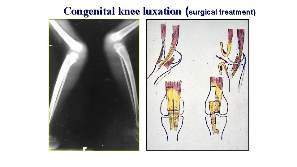 Congenital knee luxation (surgical treatment) 