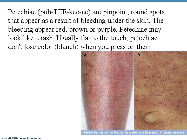 Petechiae (puh-TEE-kee-ee) are pinpoint, round spots that appear as a result of bleeding under