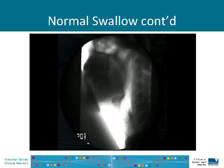 Normal Swallow cont’d Victorian Stroke Clinical Network 