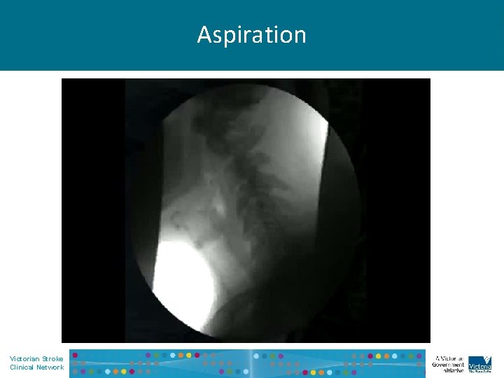 Aspiration Victorian Stroke Clinical Network 