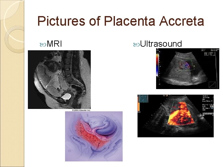 Pictures of Placenta Accreta MRI Ultrasound 