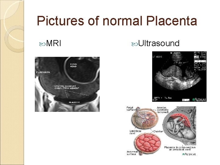 Pictures of normal Placenta MRI Ultrasound 