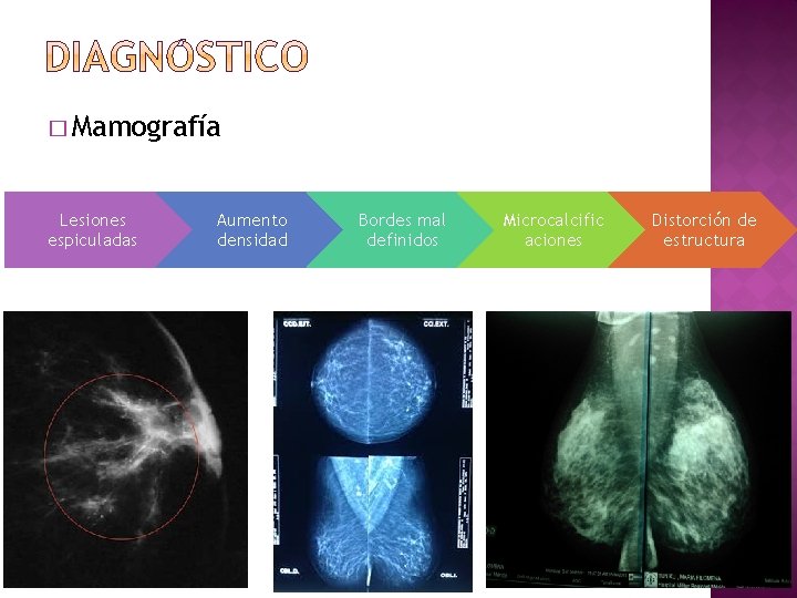 � Mamografía Lesiones espiculadas Aumento densidad Bordes mal definidos Microcalcific aciones Distorción de estructura