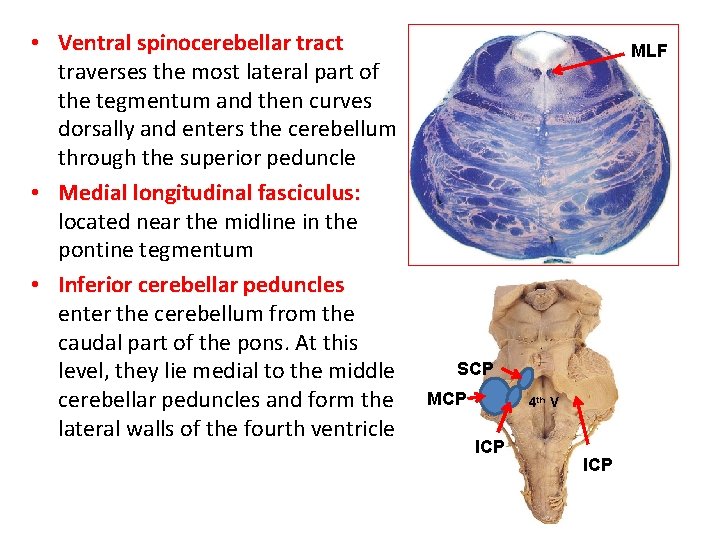  • Ventral spinocerebellar tract traverses the most lateral part of the tegmentum and