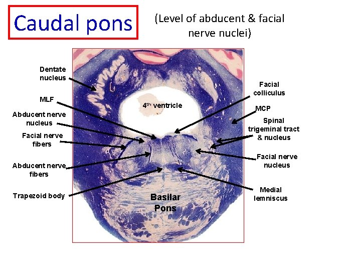 Caudal pons (Level of abducent & facial nerve nuclei) Dentate nucleus MLF Facial colliculus