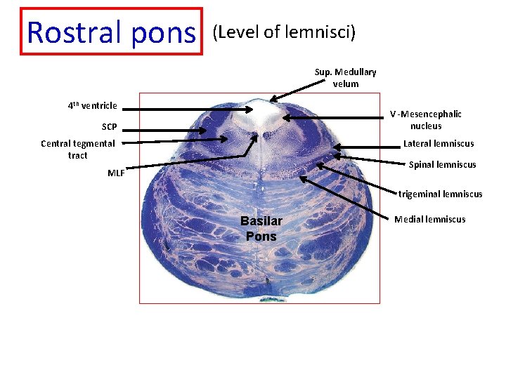 Rostral pons (Level of lemnisci) Sup. Medullary velum 4 th ventricle V -Mesencephalic nucleus