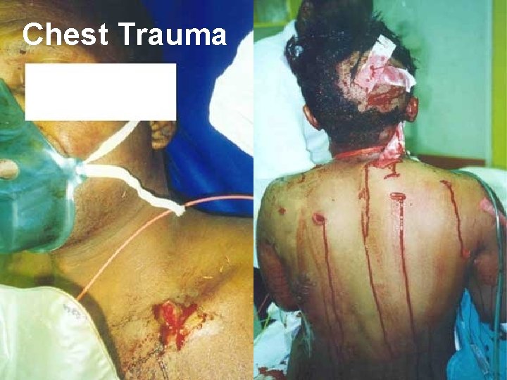 Chest Trauma 