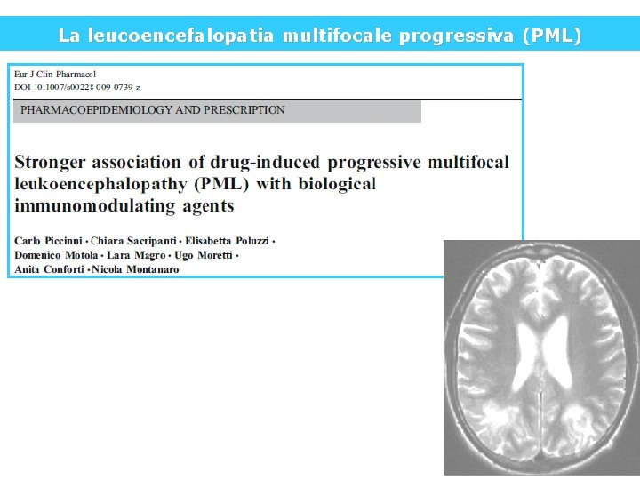 La leucoencefalopatia multifocale progressiva (PML) 