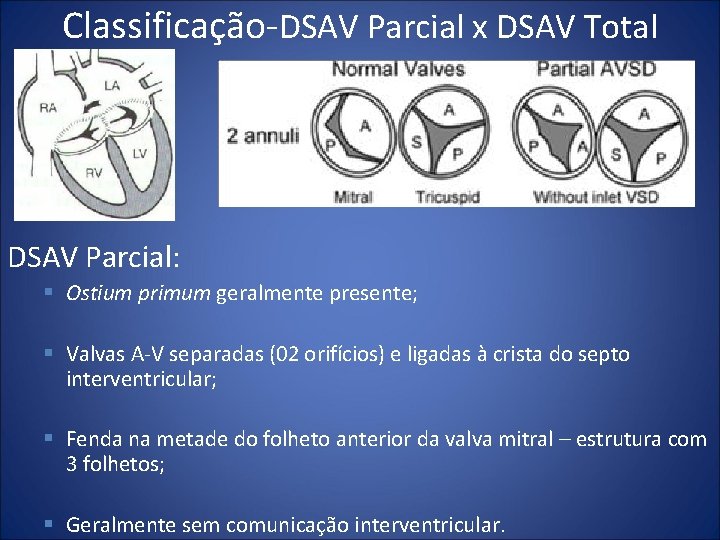 Classificação DSAV Parcial x DSAV Total DSAV Parcial: § Ostium primum geralmente presente; §