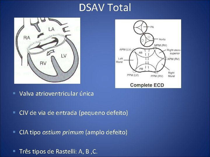 DSAV Total § Valva atrioventricular única § CIV de via de entrada (pequeno defeito)