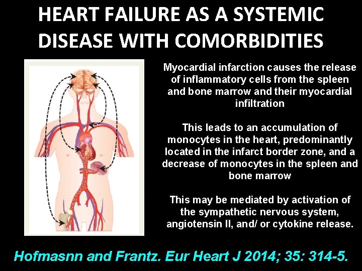 HEART FAILURE AS A SYSTEMIC DISEASE WITH COMORBIDITIES Myocardial infarction causes the release of