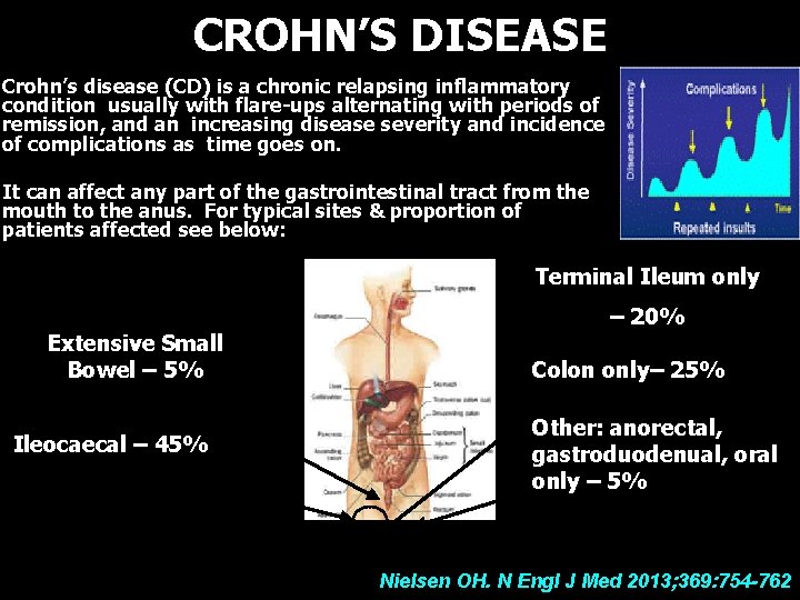 CROHN’S DISEASE Crohn’s disease (CD) is a chronic relapsing inflammatory condition usually with flare-ups
