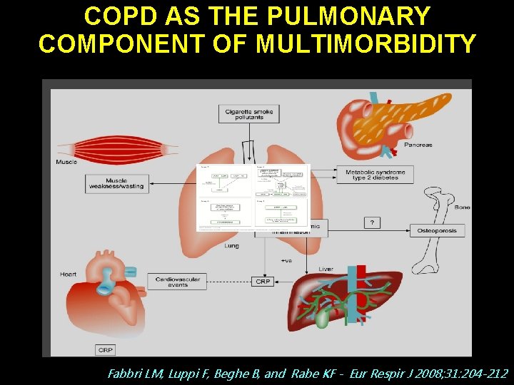 COPD AS THE PULMONARY COMPONENT OF MULTIMORBIDITY Fabbri LM, Luppi F, Beghe B, and