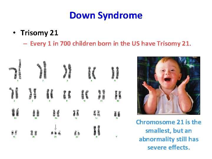 Down Syndrome • Trisomy 21 – Every 1 in 700 children born in the