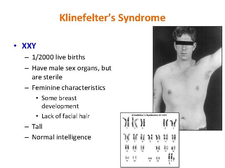 Klinefelter’s Syndrome • XXY – 1/2000 live births – Have male sex organs, but