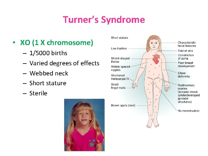 Turner’s Syndrome • XO (1 X chromosome) – – – 1/5000 births Varied degrees