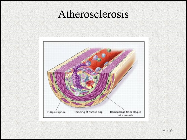 Atherosclerosis 9 / 29 