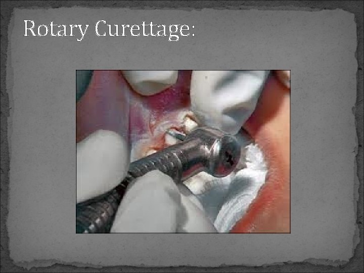 Rotary Curettage: 