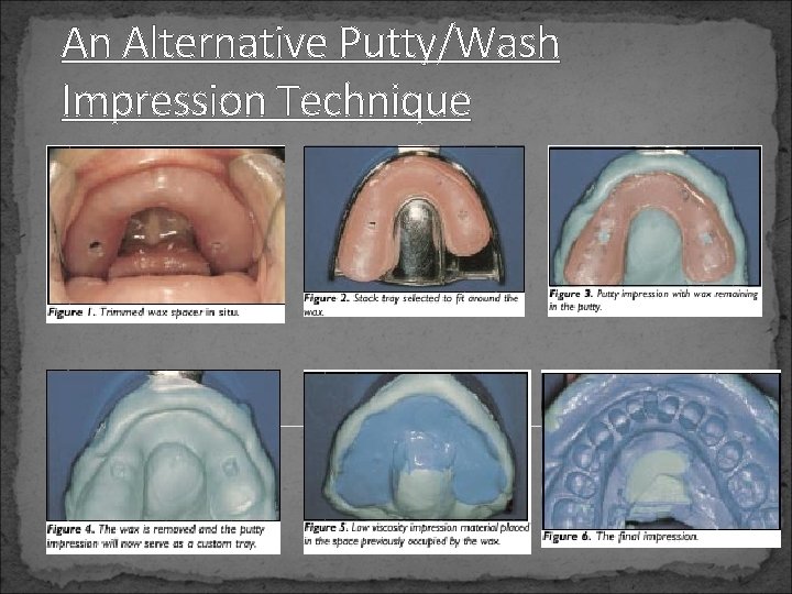 An Alternative Putty/Wash Impression Technique 