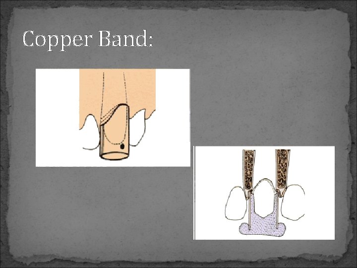 Copper Band: 