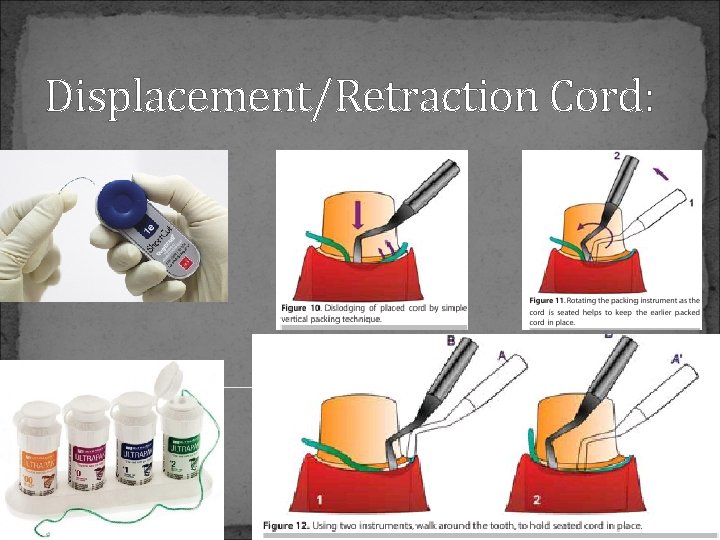 Displacement/Retraction Cord: 