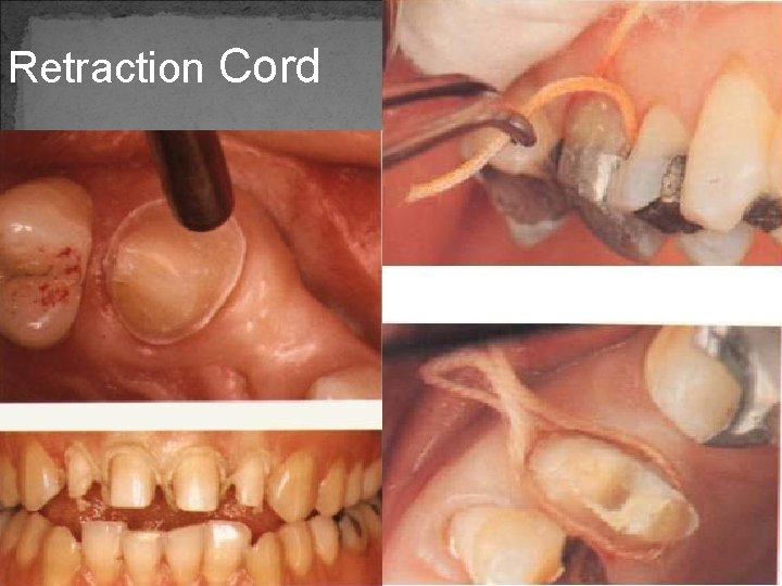 Retraction Cord 