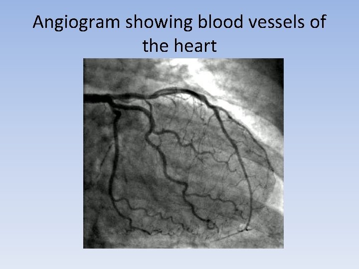 Angiogram showing blood vessels of the heart 