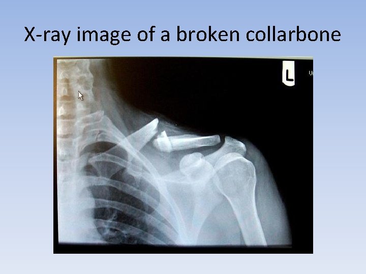 X-ray image of a broken collarbone 