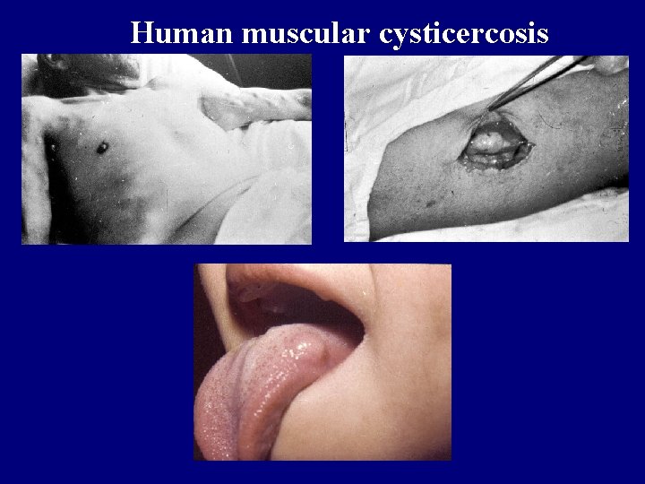 Human muscular cysticercosis 