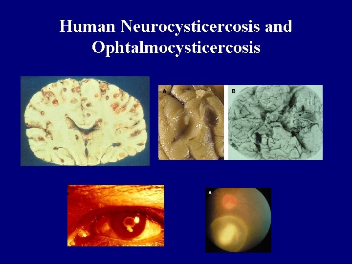 Human Neurocysticercosis and Ophtalmocysticercosis 