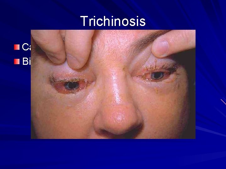 Trichinosis Caused by eating raw pork Biblical reasoning to not eat pork 