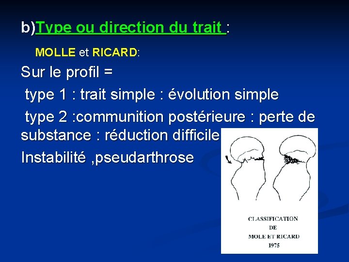 b)Type ou direction du trait : MOLLE et RICARD: Sur le profil = type