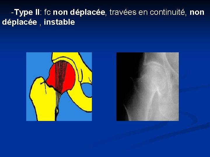 -Type II: fc non déplacée, travées en continuité, non déplacée , instable 
