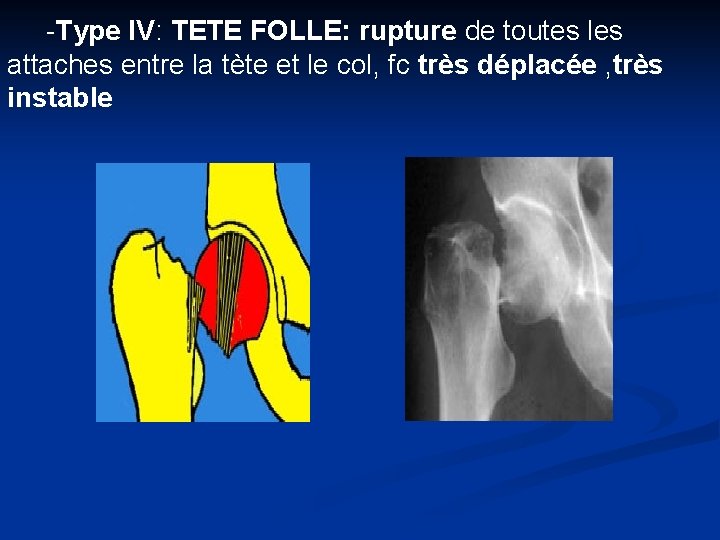 -Type IV: TETE FOLLE: rupture de toutes les attaches entre la tète et le