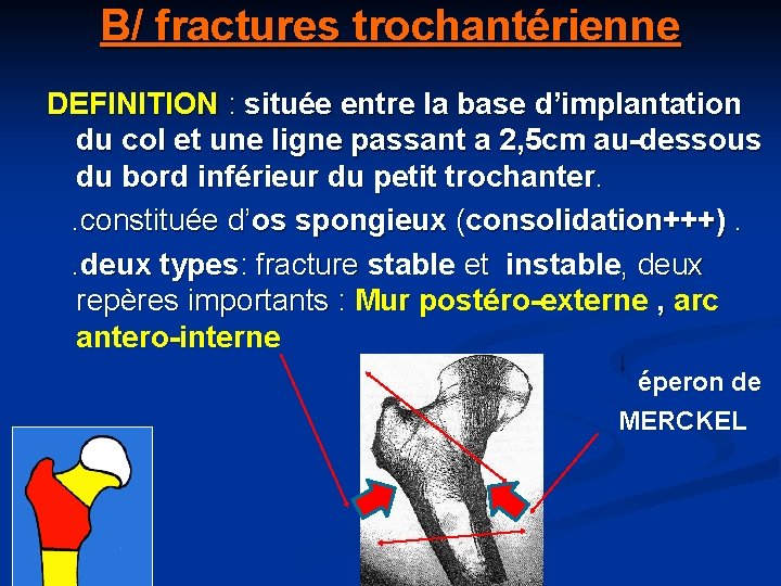 B/ fractures trochantérienne DEFINITION : située entre la base d’implantation du col et une