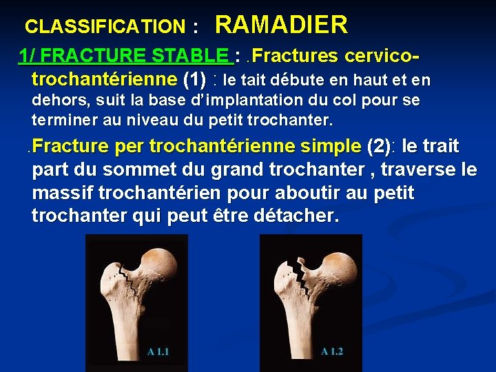 CLASSIFICATION : RAMADIER 1/ FRACTURE STABLE : . Fractures cervicotrochantérienne (1) : le tait