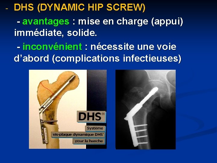 - DHS (DYNAMIC HIP SCREW) - avantages : mise en charge (appui) immédiate, solide.