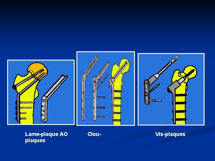 Lame-plaque AO plaques Clou- Vis-plaques 